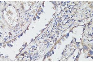 Immunohistochemistry of paraffin-embedded Human lung cancer using TrkB Polyclonal Antibody at dilution of 1:200 (40x lens). (TRKB Antikörper)