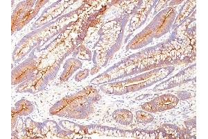 Formalin-fixed, paraffin-embedded human Colon Carcinoma stained with CEA Mouse Monoclonal Antibody (COL-1). (CEACAM5 Antikörper)