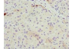 Immunohistochemistry of paraffin-embedded human liver cancer using ABIN7162309 at dilution of 1:100 (Osteocalcin Antikörper  (AA 52-100))