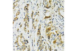 Immunohistochemistry of paraffin-embedded human colon carcinoma using TNNC1 antibody. (TNNC1 Antikörper)