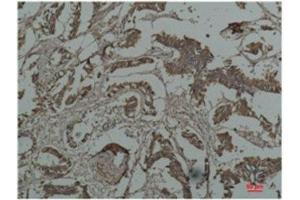 Immunohistochemistry (IHC) analysis of paraffin-embedded Human Breast Carcicnoma using HSP27 Mouse Monoclonal Antibody diluted at 1:200. (Cyclin B1 Antikörper)