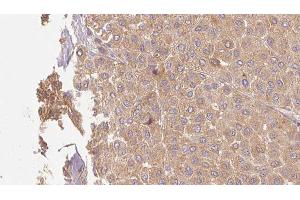 ABIN6273509 at 1/100 staining Human Melanoma tissue by IHC-P. (GZMM Antikörper  (Internal Region))