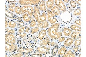 ABIN6260819 and ABIN6276752 at 1/100 staining Human kidney cancer and adjacent normal tissues by IHC-P. (CHRM1 Antikörper  (C-Term))