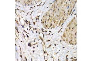 Immunohistochemistry of paraffin-embedded human gastric cancer using ISG15 Antibody (ABIN5970528) at dilution of 1/200 (40x lens). (ISG15 Antikörper)