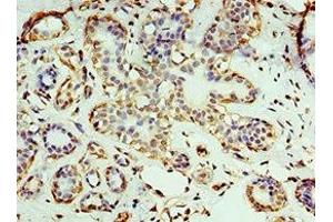 Immunohistochemistry of paraffin-embedded human breast cancer using ABIN7167670 at dilution of 1:100