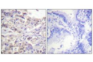 Immunohistochemical analysis of paraffin-embedded human lung carcinoma tissue using hnRPD (Phospho-Ser83) antibody (left)or the same antibody preincubated with blocking peptide (right). (HNRNPD/AUF1 Antikörper  (pSer83))