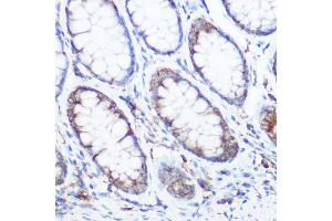 Immunohistochemistry of paraffin-embedded human colon carcinoma using NOMO1 Rabbit pAb (ABIN6128346, ABIN6144710, ABIN6144711 and ABIN6214793) at dilution of 1:350 (40x lens). (NOMO1 Antikörper  (AA 700-1000))