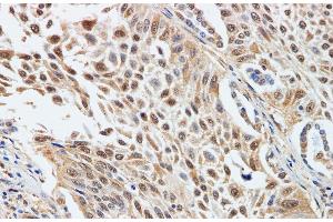 Immunohistochemistry of paraffin-embedded Human lung cancer using CDK4 Polyclonal Antibody at dilution of 1:200 (CDK4 Antikörper)