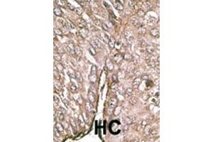 Formalin-fixed and paraffin-embedded human cancer tissue reacted with the primary antibody, which was peroxidase-conjugated to the secondary antibody, followed by DAB staining. (MAP1LC3A Antikörper  (AA 23-52))