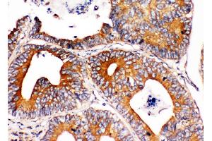 Anti-Integrin alpha 1 antibody,  IHC(P) IHC(P): Human Intestinal Cancer Tissue