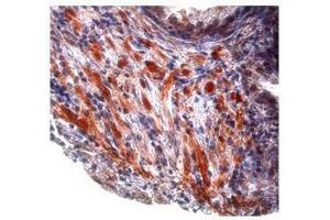 Tgf beta 1 in prostate cancer was detected using TGFB1 antibody at a dilution of 5-10 ug/ml and stained with HRP/AEC red color stain. (TGFB1 Antikörper  (Middle Region))