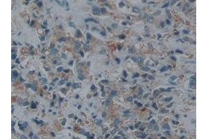 IHC-P analysis of Human Prostate cancer Tissue, with DAB staining. (ECE1 Antikörper  (AA 469-721))
