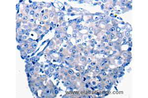Immunohistochemistry of Human breast cancer using CCL2 Polyclonal Antibody at dilution of 1:50 (CCL2 Antikörper)