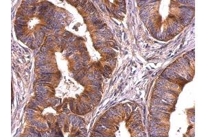IHC-P Image Survivin antibody detects Survivin protein at cytosol on human colon carcinoma by immunohistochemical analysis. (Survivin Antikörper)