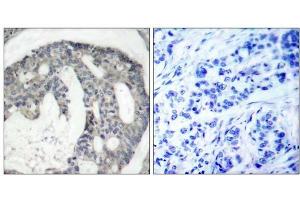 Immunohistochemical analysis of paraffin-embedded human breast carcinoma tissue using eNOS (phospho-Ser1176) antibody (E011156). (ENOS Antikörper  (pSer1176))