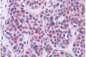 Anti-MBOAT4 antibody  ABIN1102980 IHC staining of human thyroid, medullary carcinoma. (MBOAT4 Antikörper  (Internal Region))
