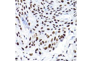 Immunohistochemistry of paraffin-embedded human esophageal cancer using K/K/TRIM28 Rabbit pAb  at dilution of 1:200 (40x lens). (KAP1 Antikörper  (AA 576-835))