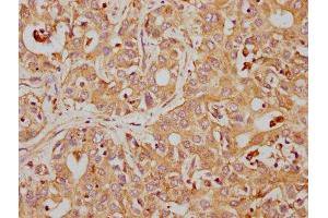IHC image of ABIN7127407 diluted at 1:155 and staining in paraffin-embedded human liver cancer performed on a Leica BondTM system.