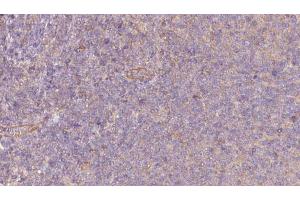 ABIN6273065 at 1/100 staining Human lymph cancer tissue by IHC-P. (PKLR Antikörper  (Internal Region))