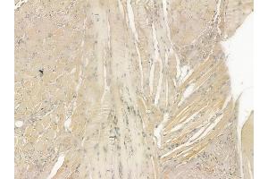 ABIN6261335 and ABIN6273228 at 1/100 staining human tongue carcinoma by IHC-P.