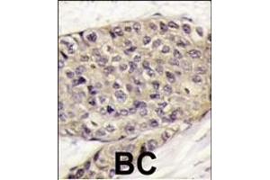 Formalin-fixed and paraffin-embedded human breast carcinoma tissue reacted with VEGF Antibody (C-term) (ABIN6242881 and ABIN6578974) , which was peroxidase-conjugated to the secondary antibody, followed by DAB staining. (VEGF Antikörper  (C-Term))