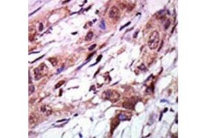 IHC analysis of FFPE human breast carcinoma tissue stained with the AURKC antibody (Aurora Kinase C Antikörper  (C-Term))