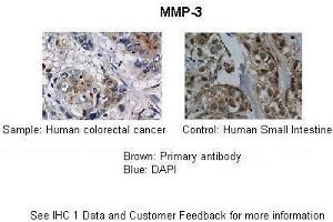Application: IHC Species+tissue/cell type: Control-Human small intestine, Sample-human colorectal cancer Primary antibody dilution: 1:100 Secondary antibody: Biotinylated pig anti-rabbit+streptavidin-HRP (MMP3 Antikörper  (Middle Region))