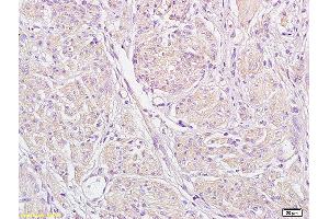 Formalin-fixed and paraffin embedded human endometrial carcinoma labeled with Anti-STIM1 Polyclonal Antibody, Unconjugated (ABIN1387605) at 1:200 followed by conjugation to the secondary antibody and DAB staining (STIM1 Antikörper  (AA 85-180))