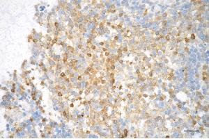 Immunohistochemistry was performed on paraffin-embedded human tonsillitis using active + pro caspase 3 antibody (ABIN7797489), 1:200). (Rekombinanter Active+pro Caspase 3 Antikörper)