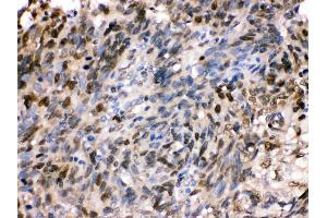 Anti- HSPA2 Picoband antibody,IHC(P) IHC(P): Human Lung Cancer Tissue (HSPA2 Antikörper  (C-Term))