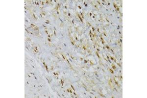 Immunohistochemistry of paraffin-embedded human adenomyosis using HNRNPA1 Antibody (ABIN5975570) at dilution of 1/100 (40x lens). (HNRNPA1 Antikörper)
