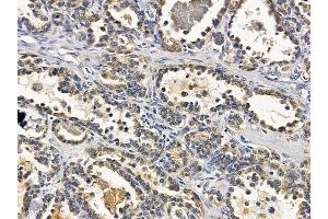 ABIN6258547 and ABIN6275031 at 1/100 staining human ovarian cancer by IHC-P.