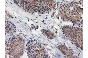 Immunohistochemical staining of paraffin-embedded Adenocarcinoma of Human breast tissue using anti-GBA3 mouse monoclonal antibody. (GBA3 Antikörper  (AA 1-150, AA 370-469))