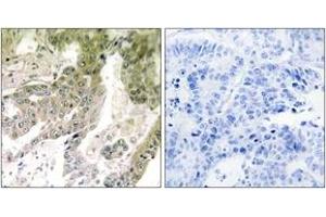 Immunohistochemistry analysis of paraffin-embedded human lung carcinoma tissue, using LAMA5 Antibody.