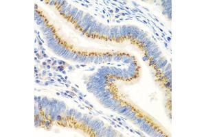 Immunohistochemistry of paraffin-embedded human colon carcinoma using UBI antibody (ABIN6134946, ABIN6149845, ABIN6149848 and ABIN6223555) at dilution of 1:100 (40x lens). (UBIAD1 Antikörper  (AA 1-100))