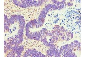Immunohistochemistry of paraffin-embedded human ovarian cancer using ABIN7144840 at dilution of 1:100 (ATP5B Antikörper  (AA 230-529))