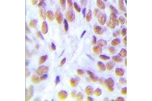 Immunohistochemical analysis of Glucocorticoid Receptor staining in human breast cancer formalin fixed paraffin embedded tissue section. (Glucocorticoid Receptor Antikörper)