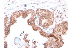 Formalin-fixed, paraffin-embedded human Prostate Carcinoma stained with CD47 Mouse Monoclonal Antibody (IAP/2937). (CD47 Antikörper  (AA 18-135))
