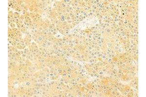 ABIN6261135 and ABIN6278939 at 1/100 staining human hepatocellular carcinoma by IHC-P. (CYB5R4 Antikörper  (N-Term))