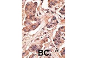 Formalin-fixed and paraffin-embedded human cancer tissue reacted with the primary antibody, which was peroxidase-conjugated to the secondary antibody, followed by DAB staining. (MAGEH1 Antikörper  (C-Term))