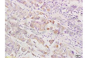 Formalin-fixed and paraffin embedded human gastric carcinoma labeled with Anti-MEK1/2(MAPKK1) Polyclonal Antibody, Unconjugated (ABIN736791) at 1:200 followed by conjugation to the secondary antibody and DAB staining. (MEK1/2 Antikörper  (AA 301-393))