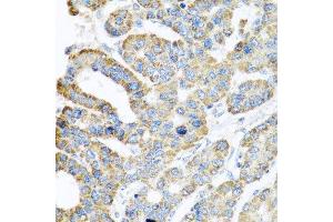 Immunohistochemistry of paraffin-embedded human liver cancer using ATPIF1 antibody at dilution of 1:100 (x40 lens).