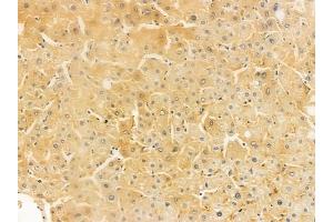 ABIN6259299 and ABIN6275274 at 1/100 staining human hepatocellular carcinoma by IHC-P.