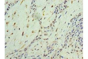 Immunohistochemistry of paraffin-embedded human breast cancer using ABIN7161910 at dilution of 1:100 (NR4A1 Antikörper  (AA 1-170))