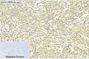 Immunohistochemical analysis of paraffin-embedded human breast cancer tissue. (ABCB5 Antikörper)