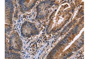 The image on the left is immunohistochemistry of paraffin-embedded Human colon cancer tissue using ABIN7129424(FAAH2 Antibody) at dilution 1/30, on the right is treated with fusion protein. (FAAH2 Antikörper)