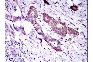 Immunohistochemical analysis of paraffin-embedded esophageal cancer tissues using DNAL4 mouse mAb with DAB staining. (DNAL4 Antikörper  (AA 1-105))
