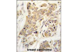 Formalin-fixed and paraffin-embedded human breast carcinoma tissue reacted with CDH8 antibody , which was peroxidase-conjugated to the secondary antibody, followed by DAB staining. (Cadherin 8 Antikörper  (N-Term))