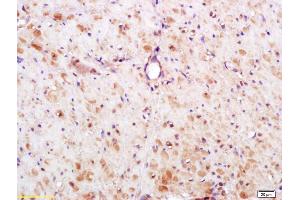 Formalin-fixed and paraffin embedded human gastric carcinoma labeled with Anti-S100A13 Polyclonal Antibody, Unconjugated (ABIN748073) at 1:200 followed by conjugation to the secondary antibody and DAB staining.
