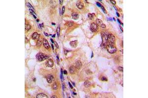Immunohistochemical analysis of Histone Deacetylase 8 (pS39) staining in human lung cancer formalin fixed paraffin embedded tissue section.